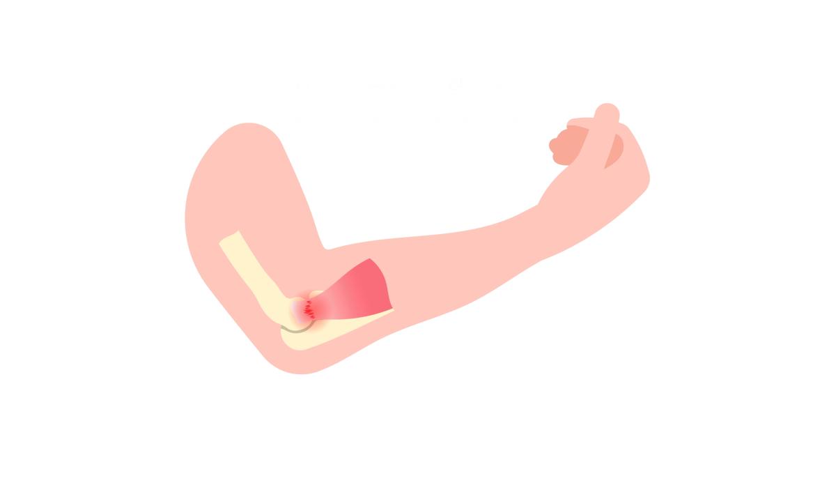 Tennisarm illustratie