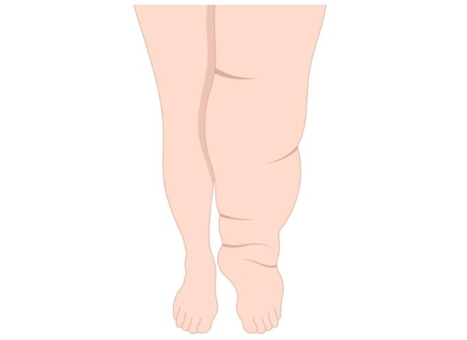 Vocht en zwelling illustratie