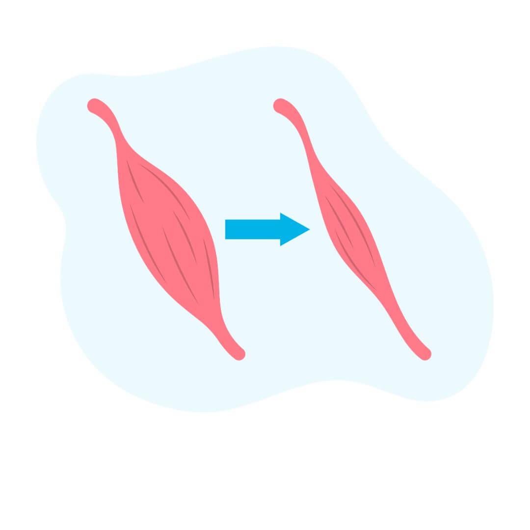 Dystrofie illustratie