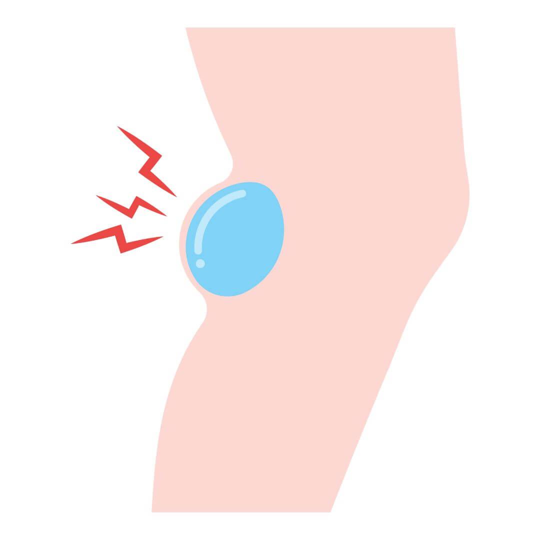 Bakers' cyste illustratie