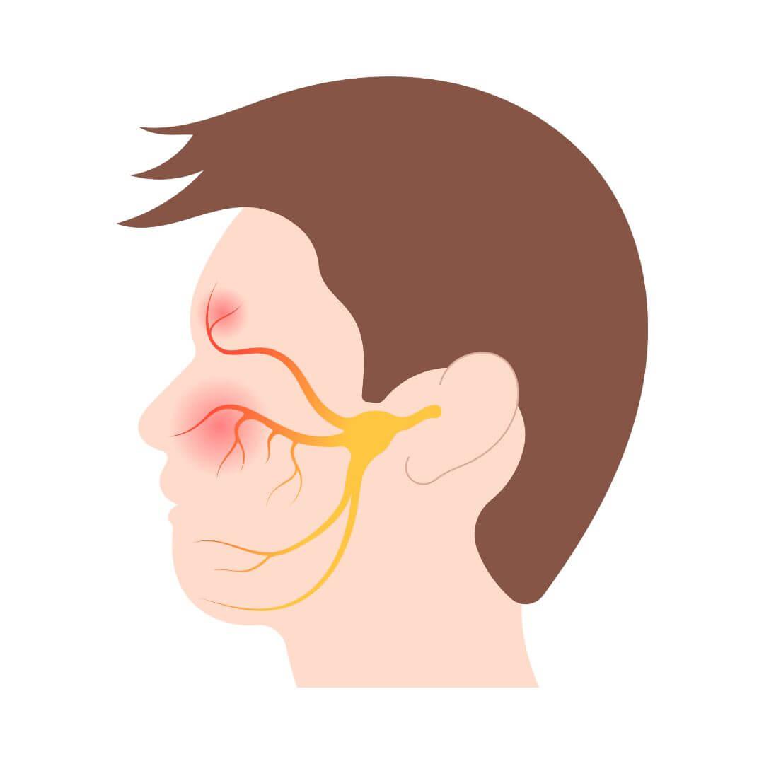 Bellse parese illustratie