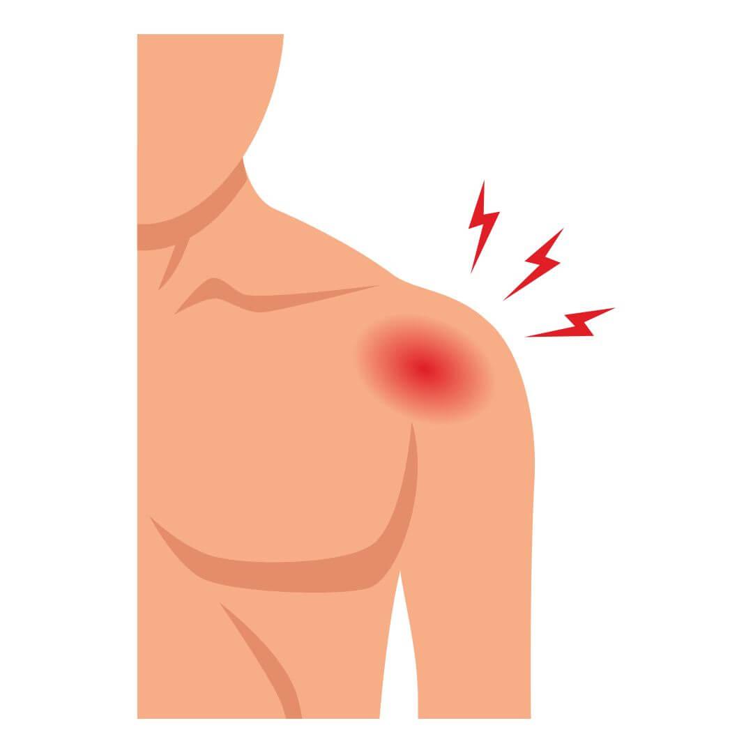 Frozen shoulder illustratie