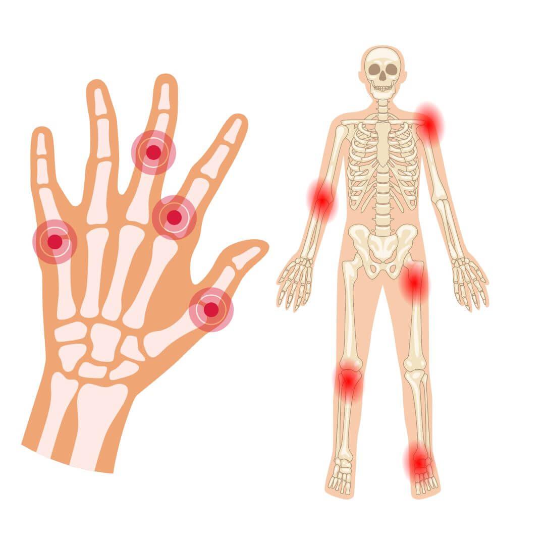 Gewrichtsontsteking illustratie