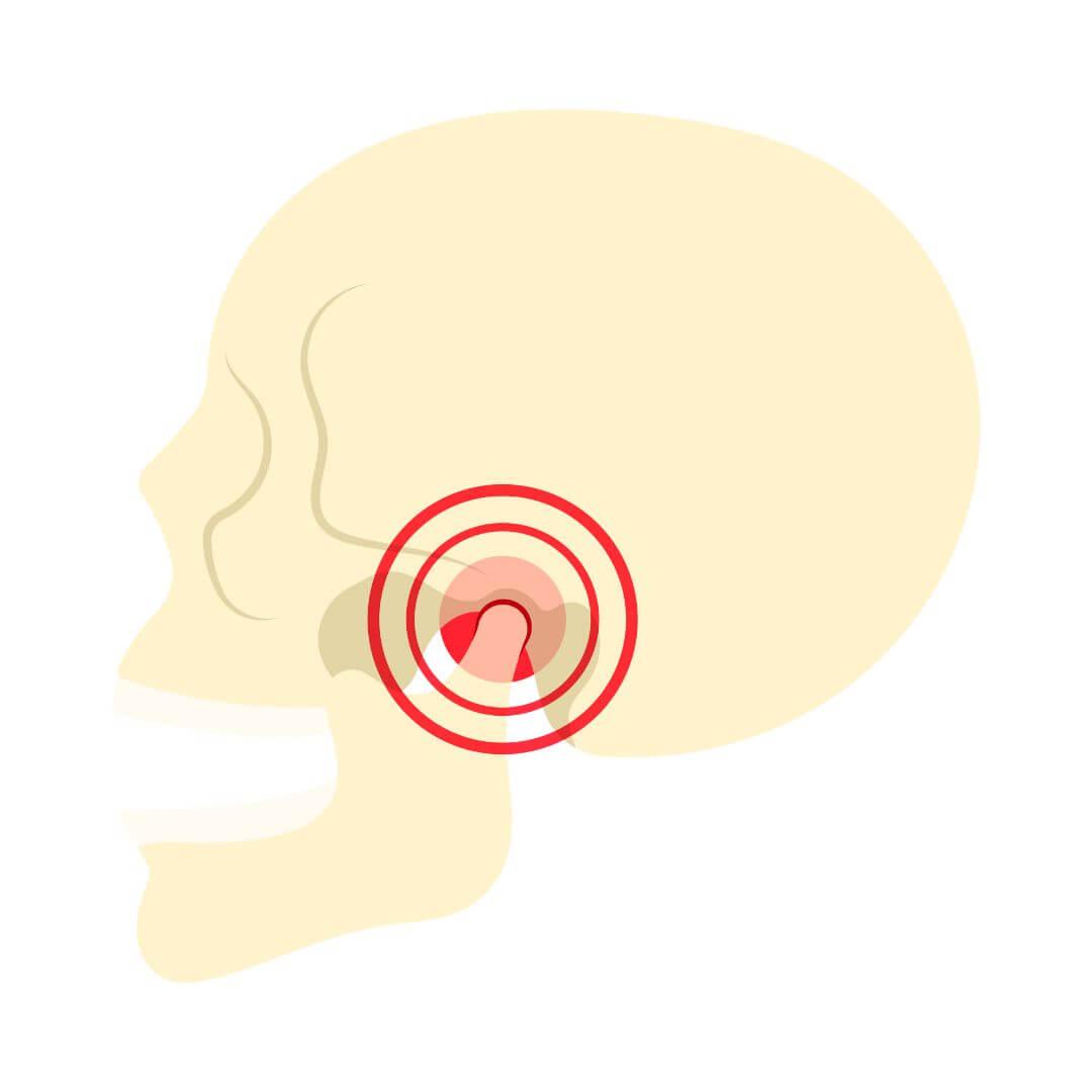 Kaakklachten Illustratie