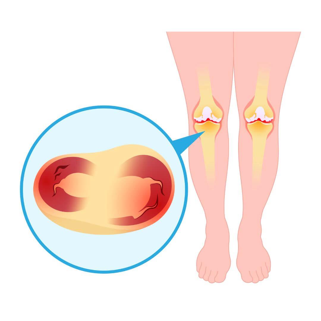 Meniscusklachten illustratie