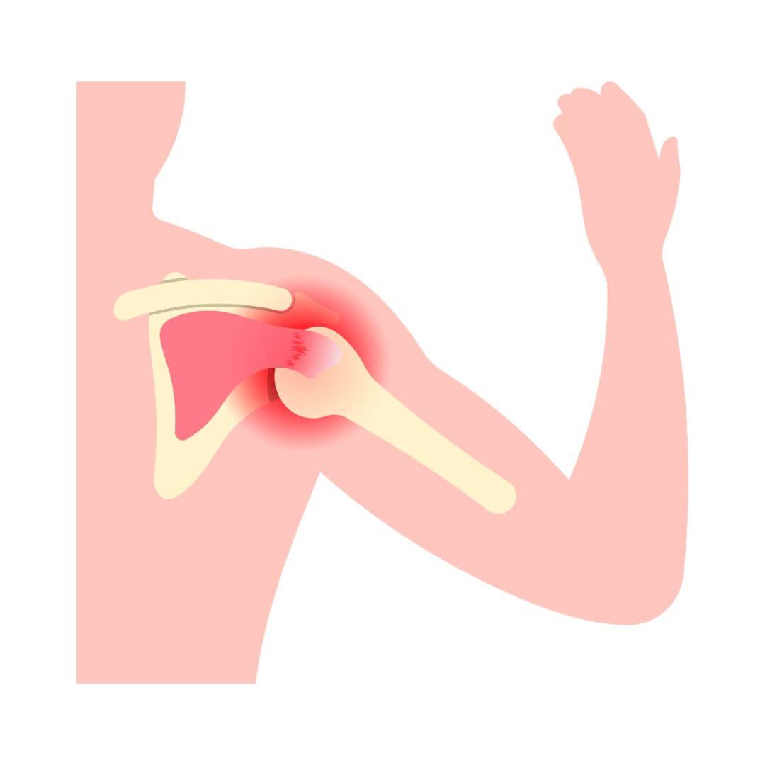 schouder impingement illustratie