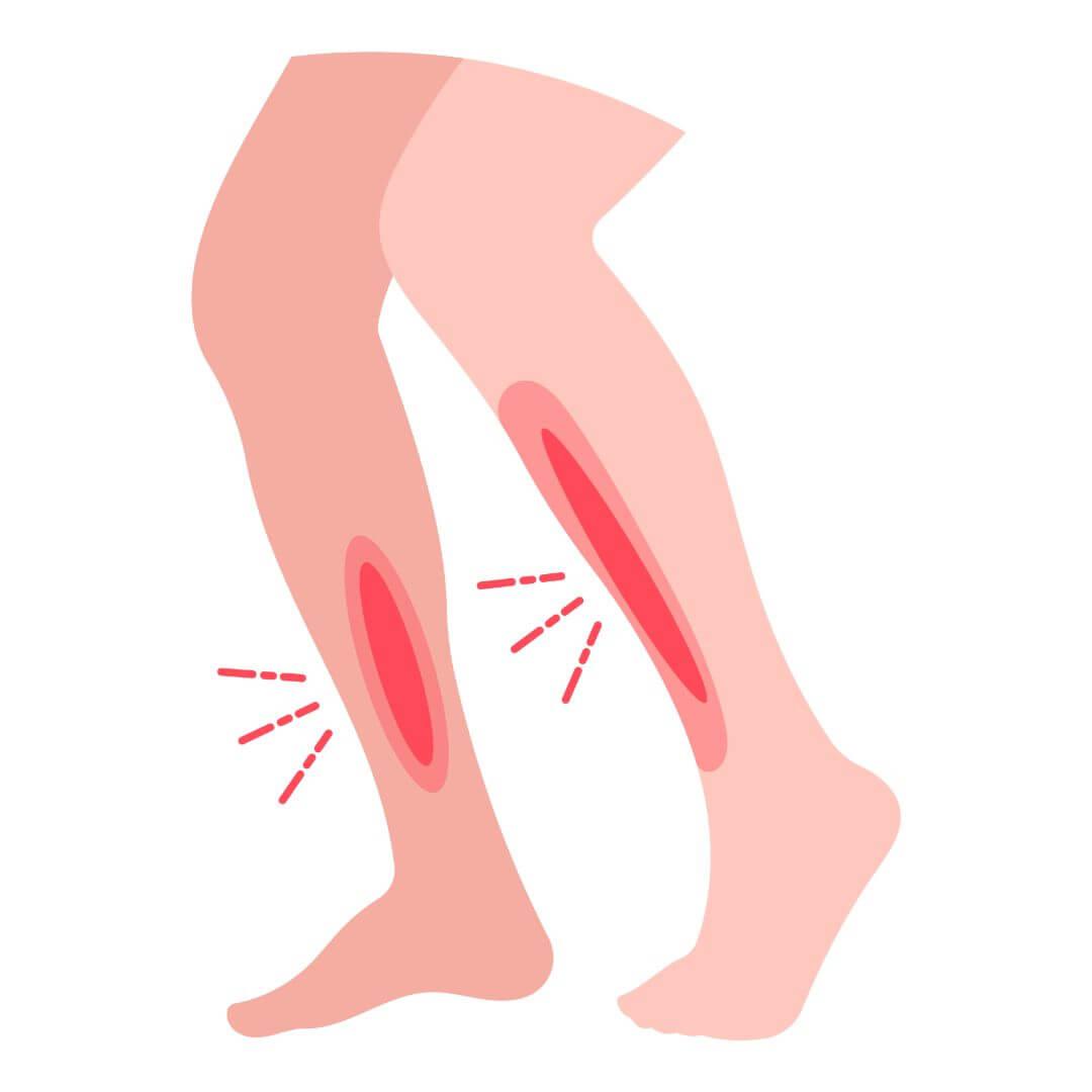 Shin splints illustratie
