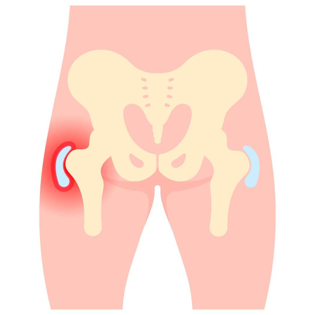 Slijmbeursontsteking illustratie