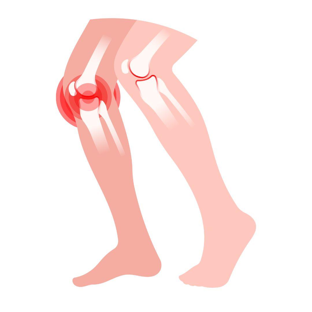 Patellapeesontsteking illustratie