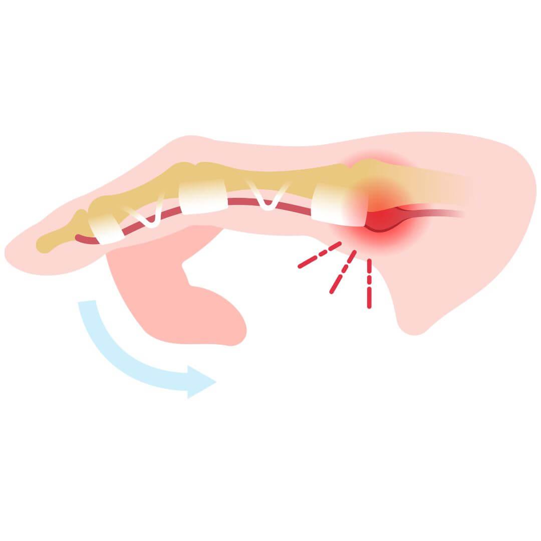 trigger finger illustratie