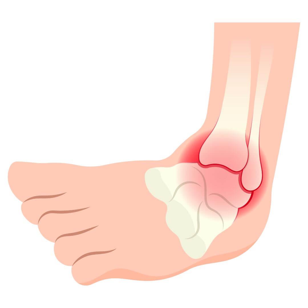 Verstuiking illustratie