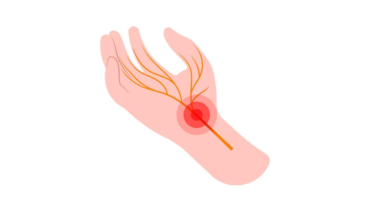 Carpaal tunnelsyndroom illustratie