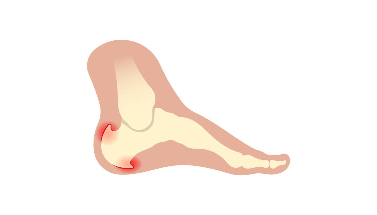 Hielspoor behandeling met laser