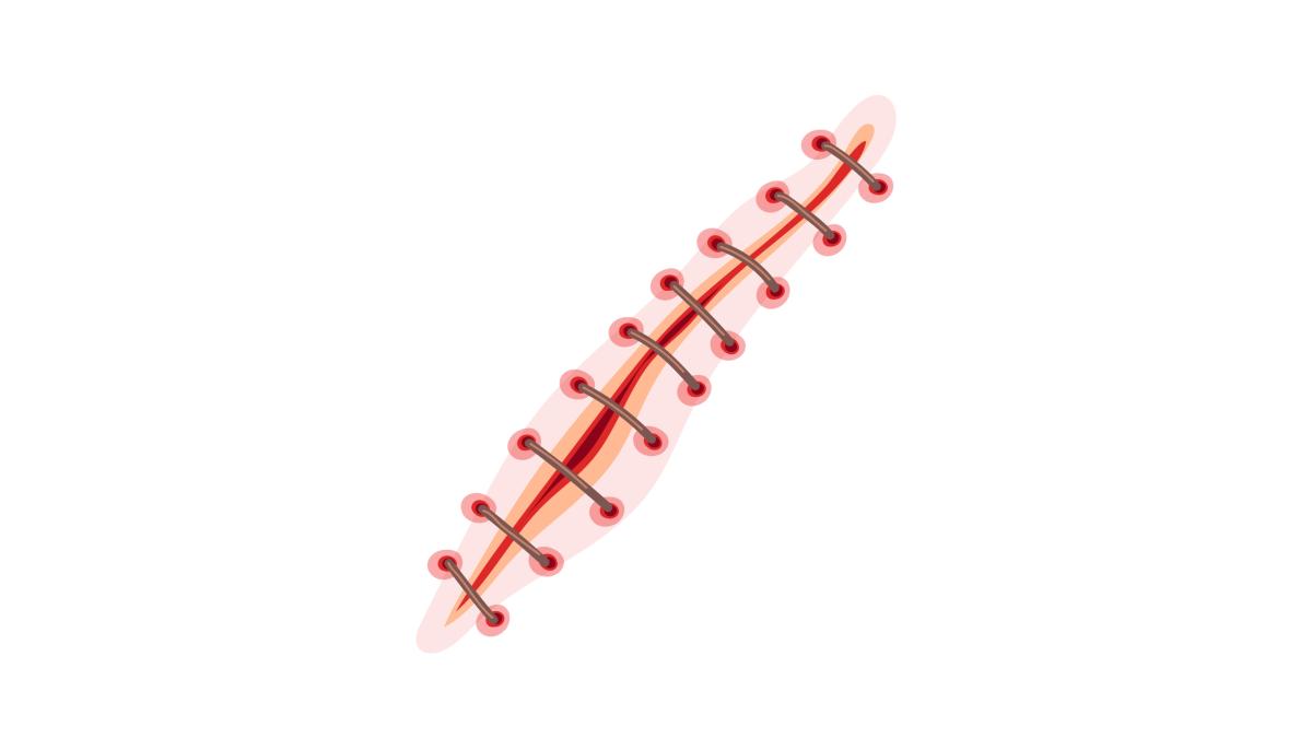 Litteken illustratie