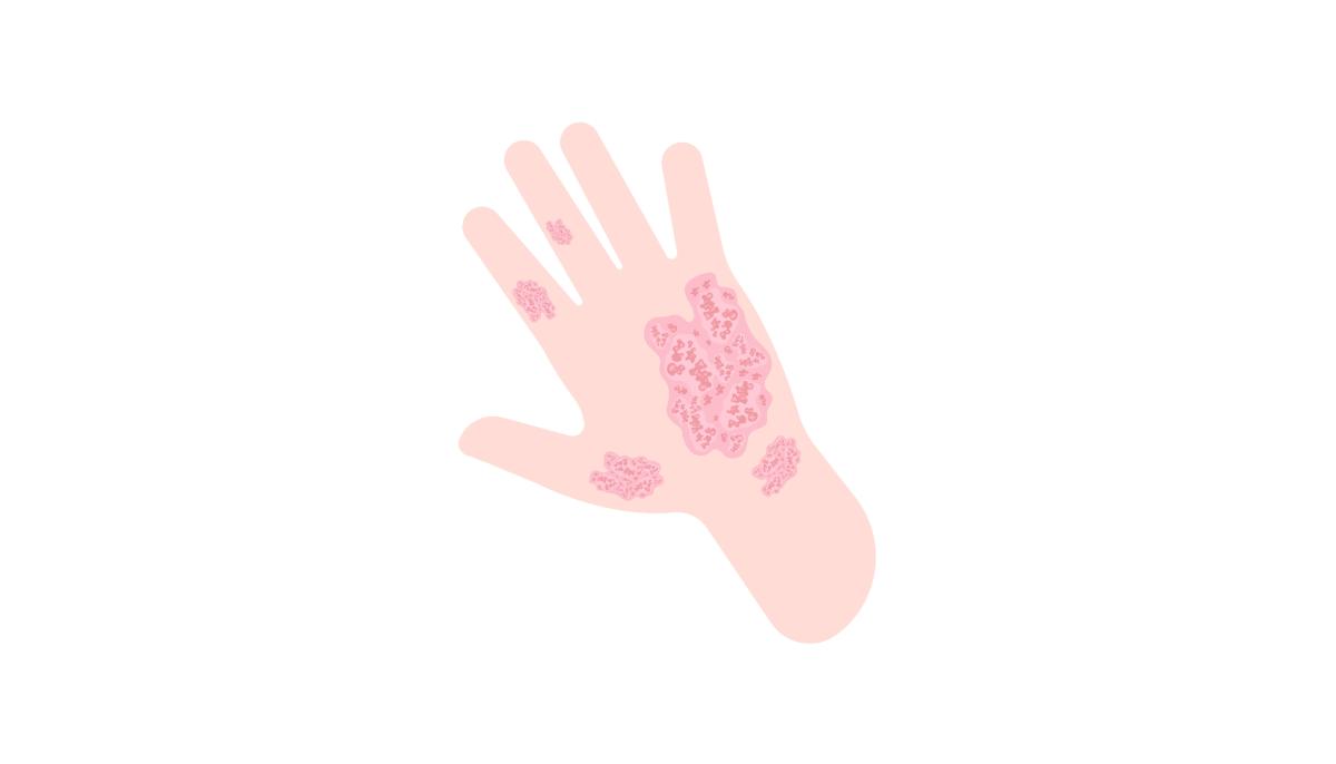 Psoriasis illustratie