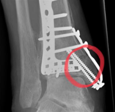 Herstel na een botbreuk