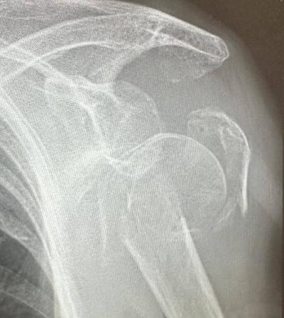 schouderbreuk bij 95 jaar