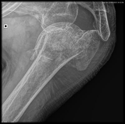 schouderbreuk bij 95 jaar